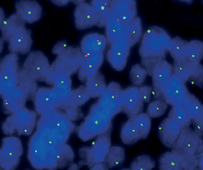 Fluoreszenzaufnahme von Zellen eines Hochrisiko-Hirntumors (Ependymom).